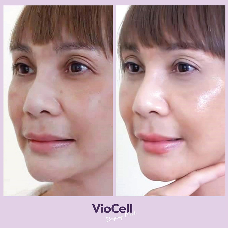 คุณหน่อย-VioCell-Before-After