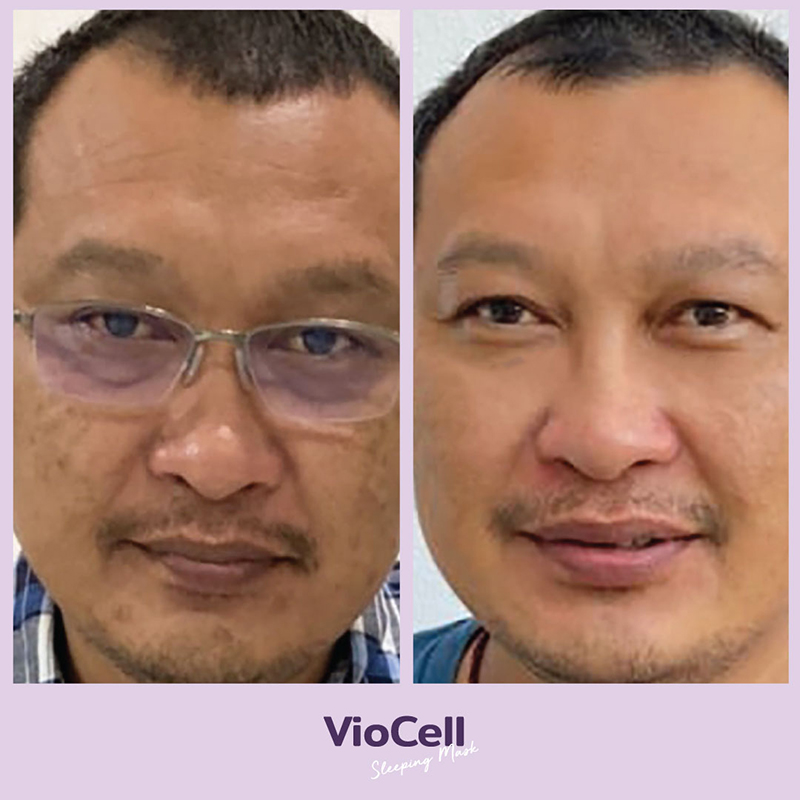 คุณ-Por-VioCell-Before-After