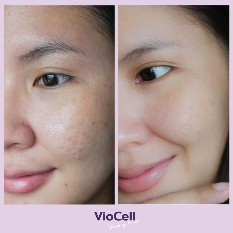 VioCell-Before-After-คุณAnne